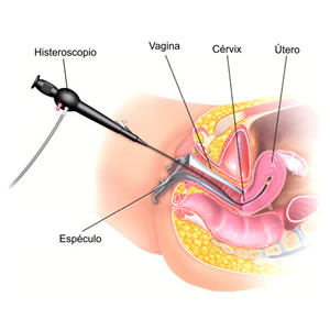 Histeroscopia