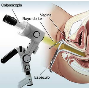 Colposcopía